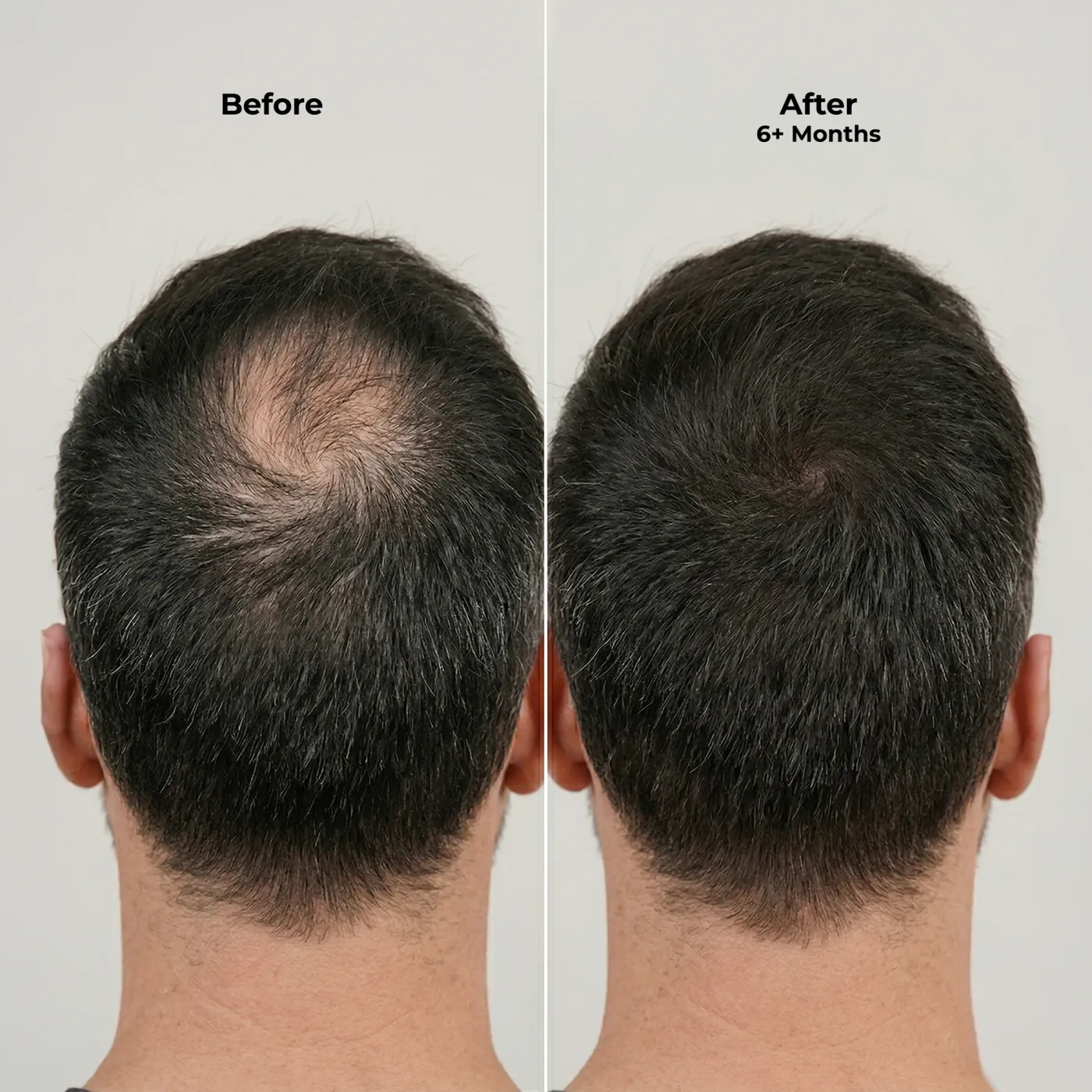Ghori® dermaroller laid flat beside its case and cleaning cap on a pale surface