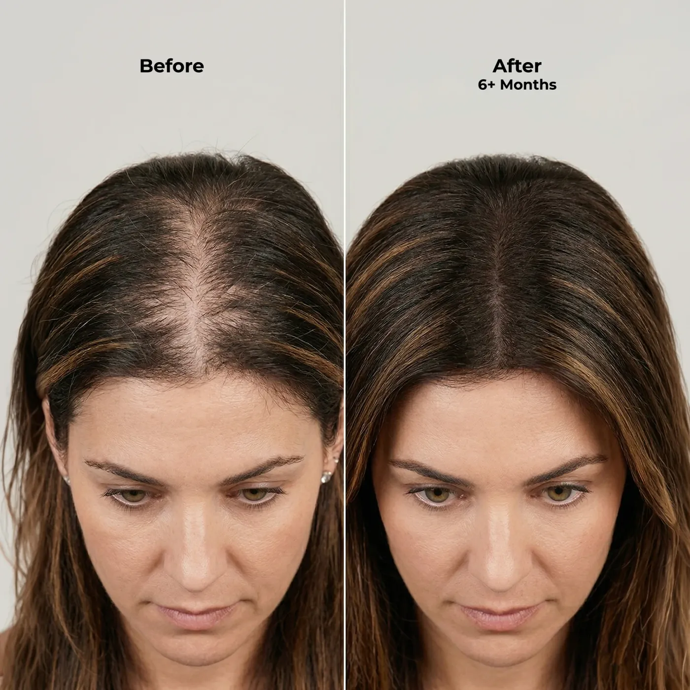 Ghori® dermaroller in use on the scalp hairline, demonstrating the rolling direction